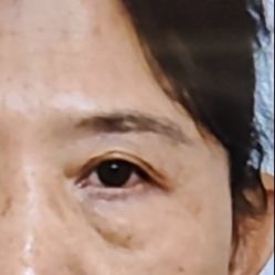 -广州健丽·去眼袋医疗美容机构