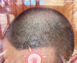 -大麦微针植发全国连锁