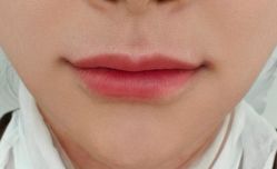 体验后-深圳美莱医疗美容医院