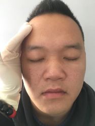 操作前-杨丹国际美学肌研所