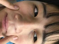 -美丽人生祛斑扁平疣汗管瘤中心