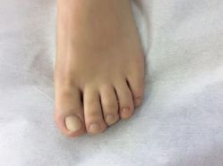 -德哥灰指甲脚气甲沟炎跖疣护理