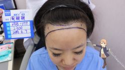 -大麦微针植发丨全国连锁