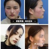 什么情况下要取出隆鼻假体？