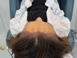 -大麦微针植发全国连锁