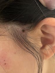-北京美痣堂古方祛痣斑疣瘊
