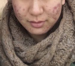 -美肤盾祛痘·问题肌头疗管理中心