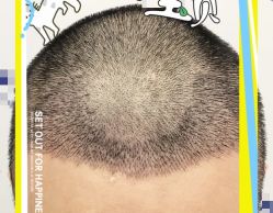 -大麦微针植发全国连锁