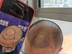 -碧莲盛·不剃发植发