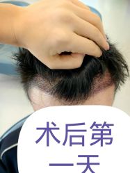 -大麦微针植发全国连锁