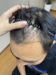 -大麦微针植发全国连锁