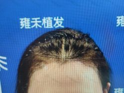 -雍禾植发全国连锁