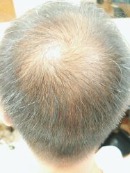 -碧莲盛·不剃发植发