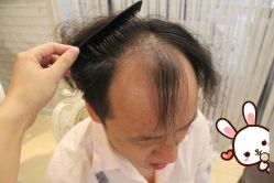 -大麦微针植发丨全国连锁