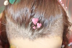 -大麦微针植发全国连锁