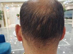 -雍禾植发全国连锁