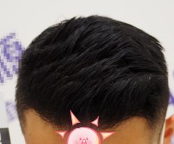 -大麦微针植发全国连锁