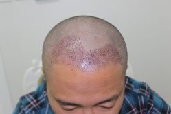 点击看大图 -大麦微针植发丨全国连锁