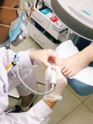 -派恩宜灰指甲鸡眼嵌甲手足癣