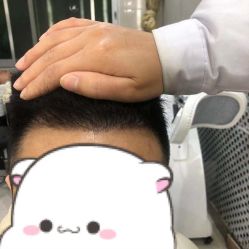 点击看大图 体验后-大麦微针植发全国连锁