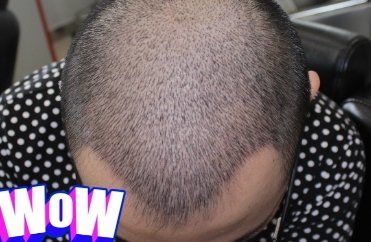 -大麦微针植发丨全国连锁