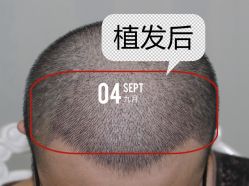 -大麦微针植发全国连锁