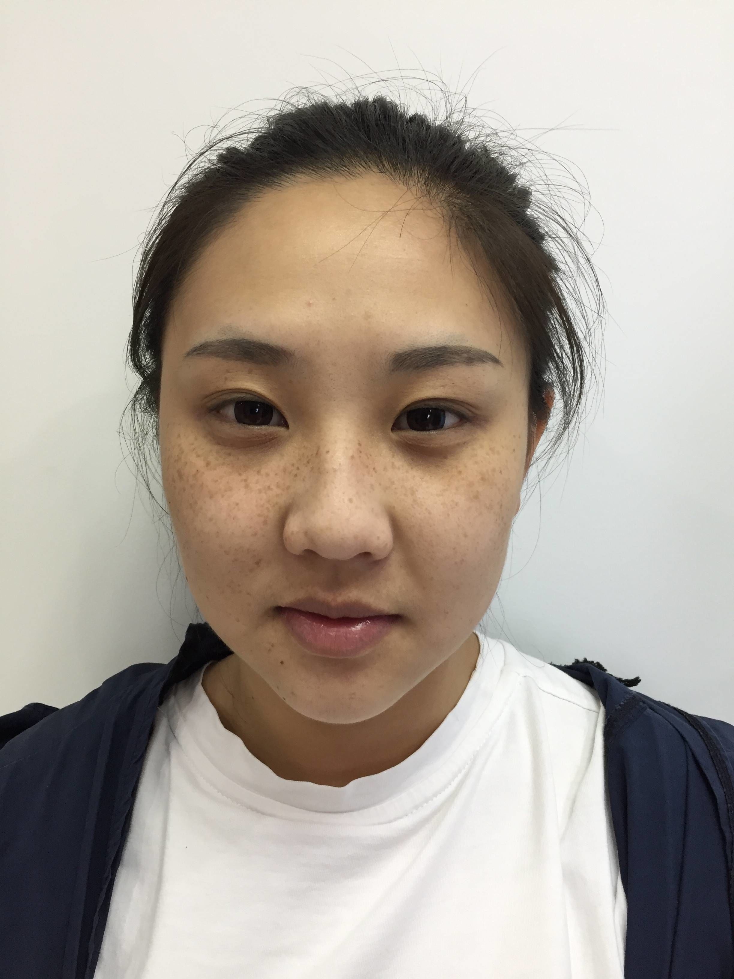 【去雀斑】体验超皮秒双机去雀斑15天后效果分享