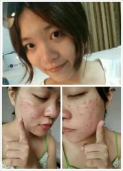 -苗方清颜专业祛痘