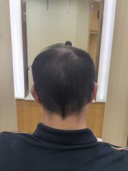 -大麦微针植发全国连锁
