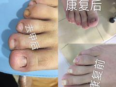 -世龙世家灰指甲·甲沟炎·跖疣护理·修脚(东江湾路店)