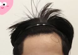 -大麦微针植发全国连锁