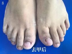 -德哥灰指甲脚气甲沟炎跖疣护理