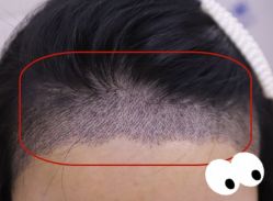 -大麦微针植发全国连锁