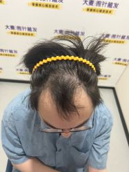 -大麦微针植发全国连锁