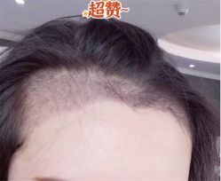 -大麦微针植发全国连锁