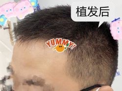 -大麦微针植发全国连锁