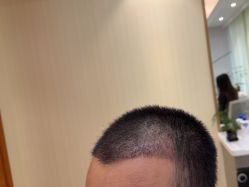 -碧莲盛·不剃发植发