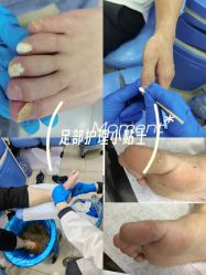 -德哥灰指甲脚气甲沟炎跖疣护理