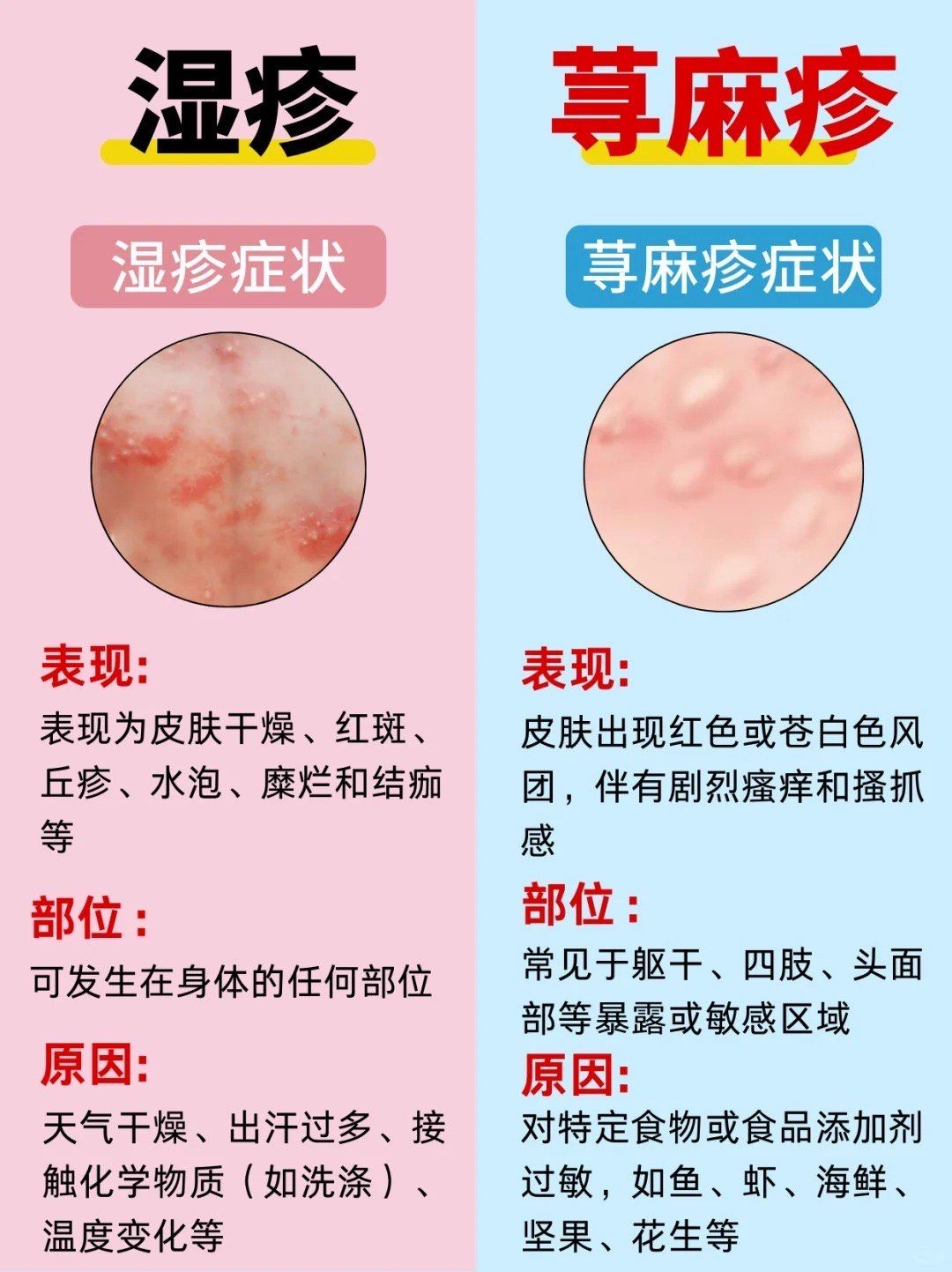 湿疹和荨麻疹你分清了吗⁉千万别搞错了!