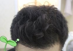 -大麦微针植发丨全国连锁