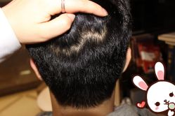 点击看大图 -大麦微针植发丨全国连锁