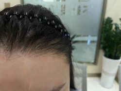 -碧莲盛·不剃发植发