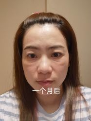 -agge蛋白医美
