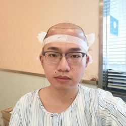 -碧莲盛·不剃发植发