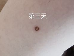 点击看大图 体验后-青岛诺德医学美容医院