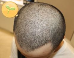 -大麦微针植发丨全国连锁