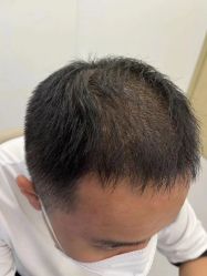 点击看大图 体验后-大麦微针植发全国连锁