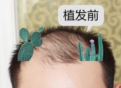-大麦微针植发全国连锁