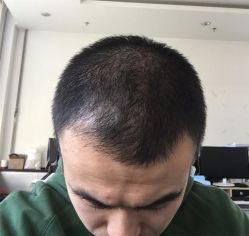 -碧莲盛·不剃发植发