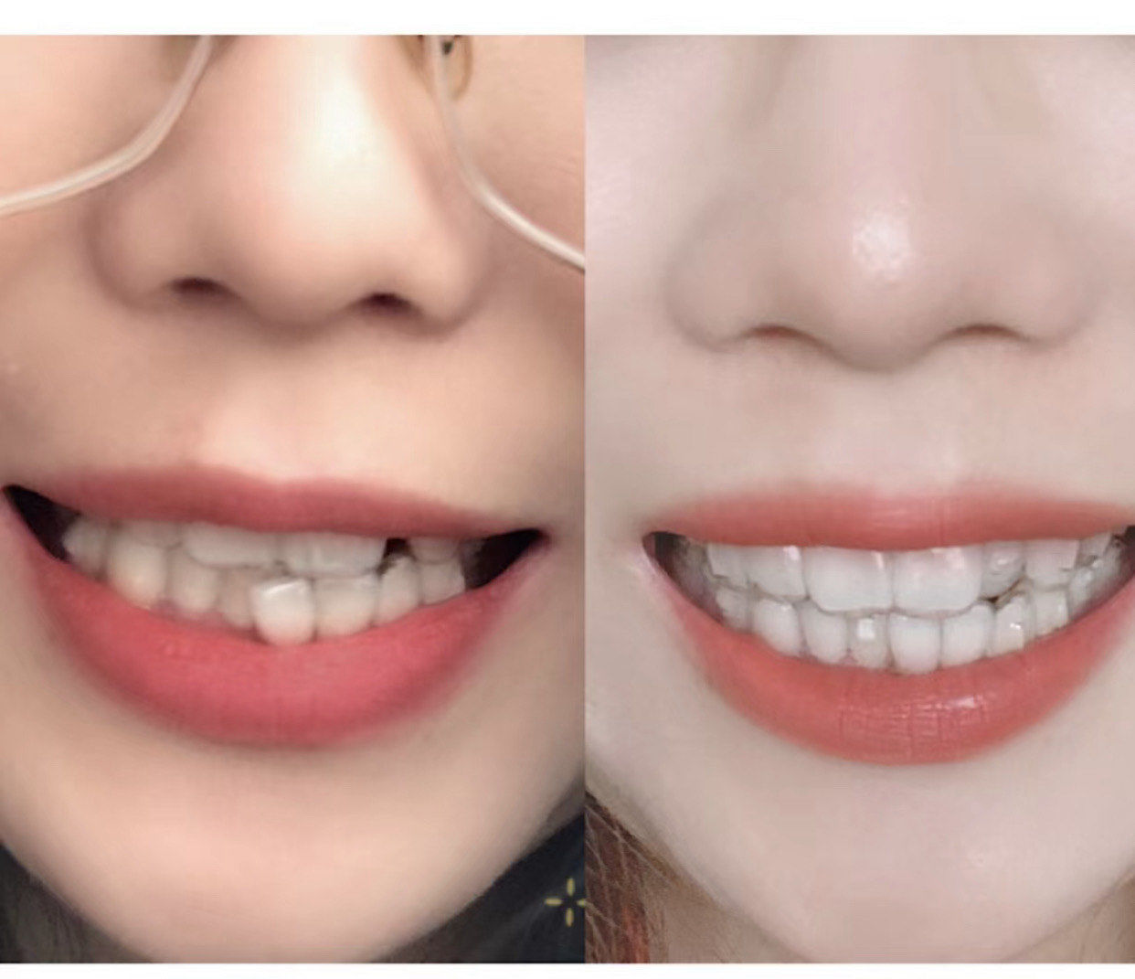 戴上了隐形牙套